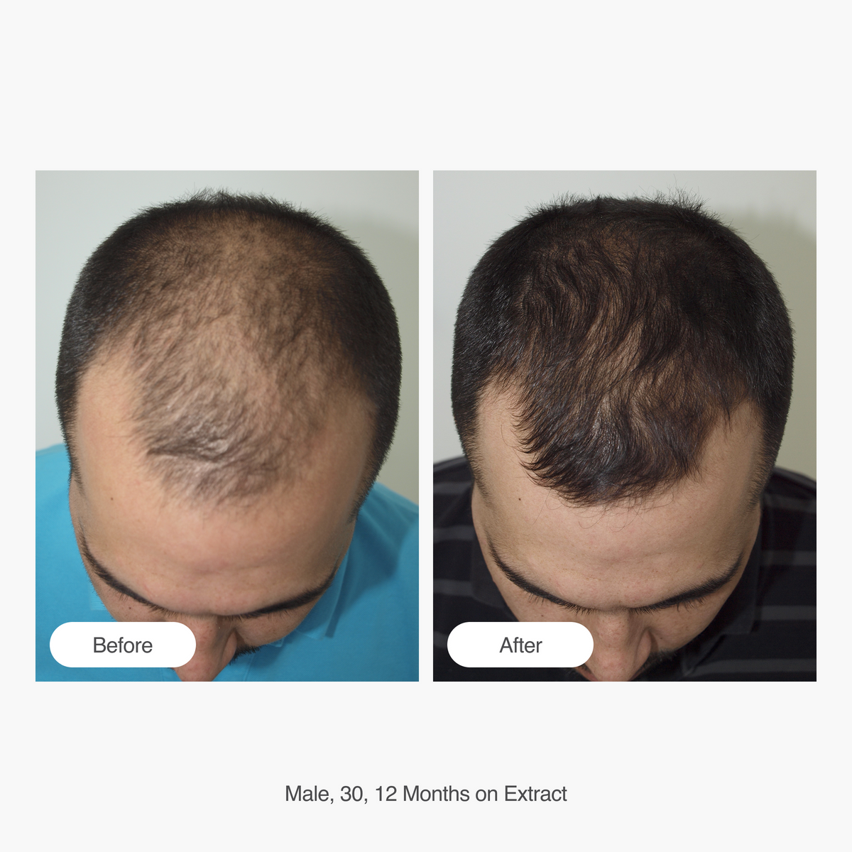 Hair Gain Extract